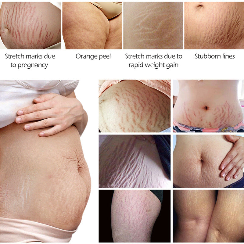 Natural cream improving skin scratch scar marks smooth skin stretch mark cream.