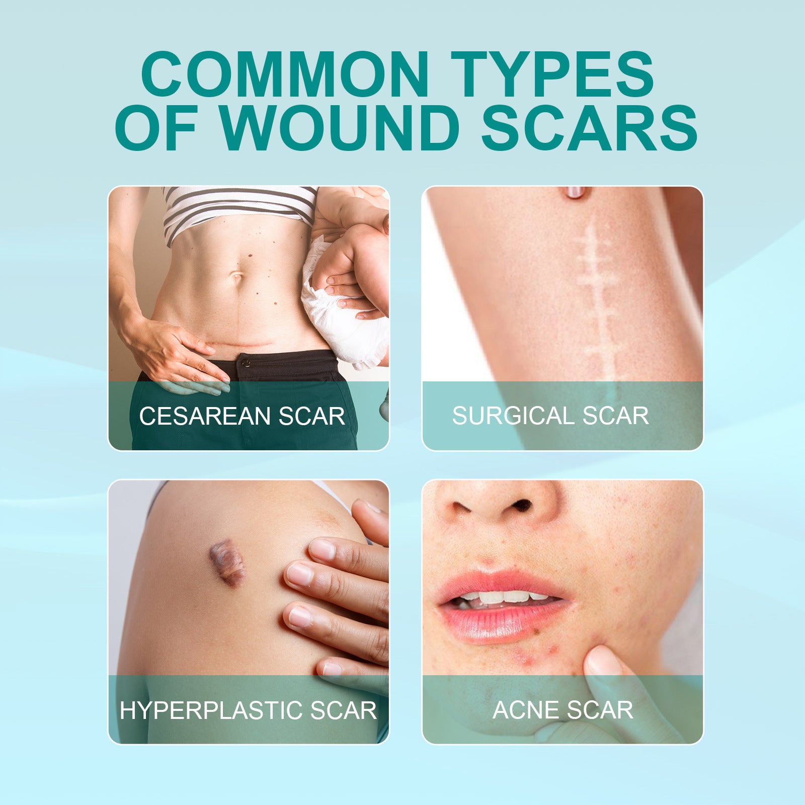 Scar removal Care Spray Lightens Scars Pregnancy and Surgery Scars Smooths Skin Care Spray