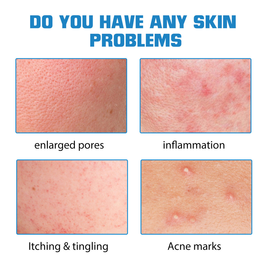 Hyaluronic Acid Essence Fades Facial Acne Marks, Hydrates, Repairs, Skin Care, Whitening Essence