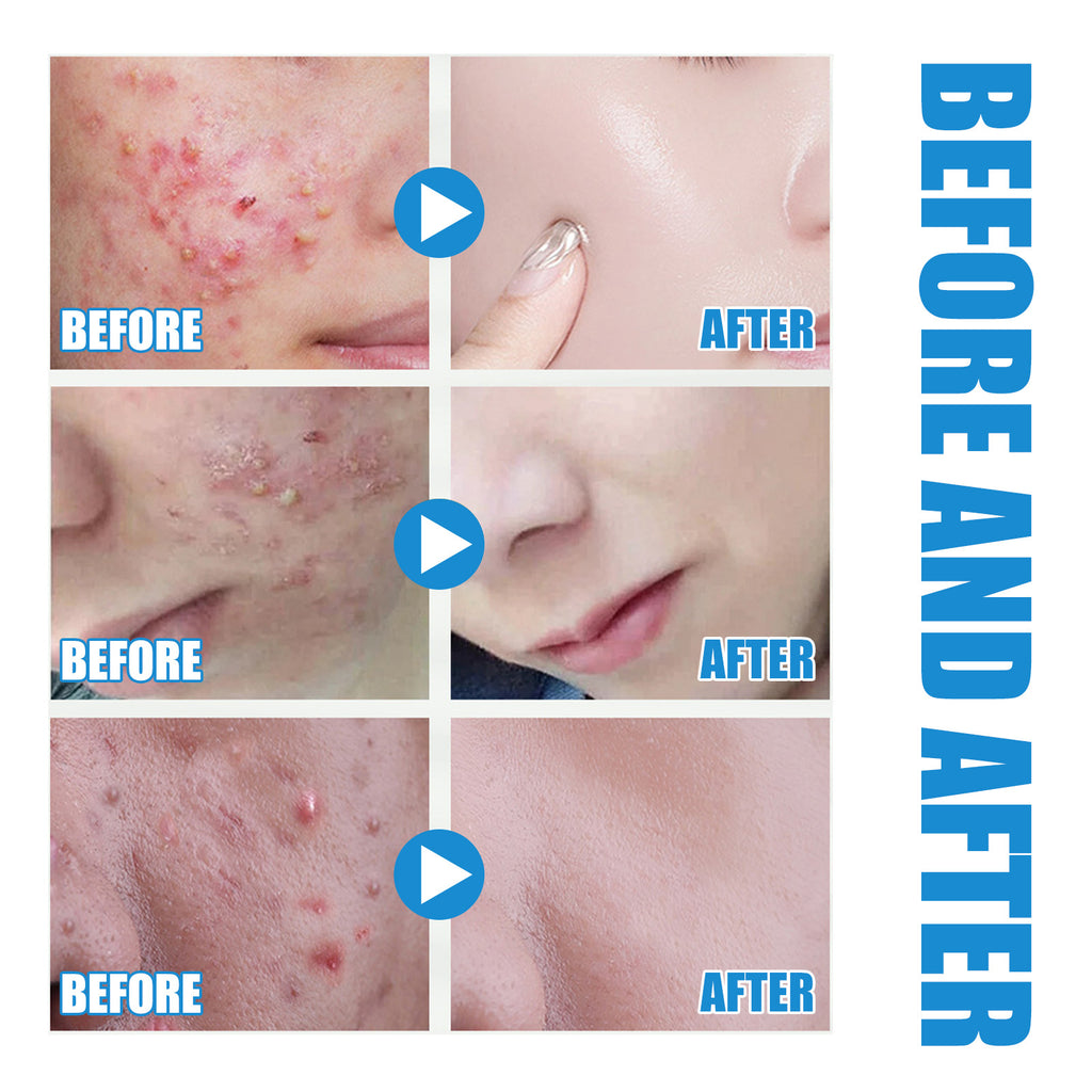 Hyaluronic Acid Essence Fades Facial Acne Marks, Hydrates, Repairs, Skin Care, Whitening Essence