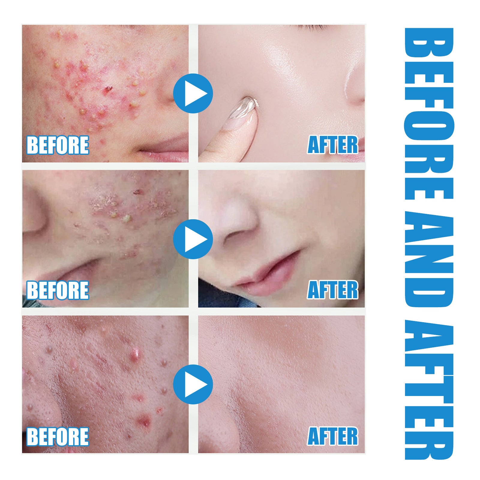 Hyaluronic Acid Essence Fades Facial Acne Marks, Hydrates, Repairs, Skin Care, Whitening Essence