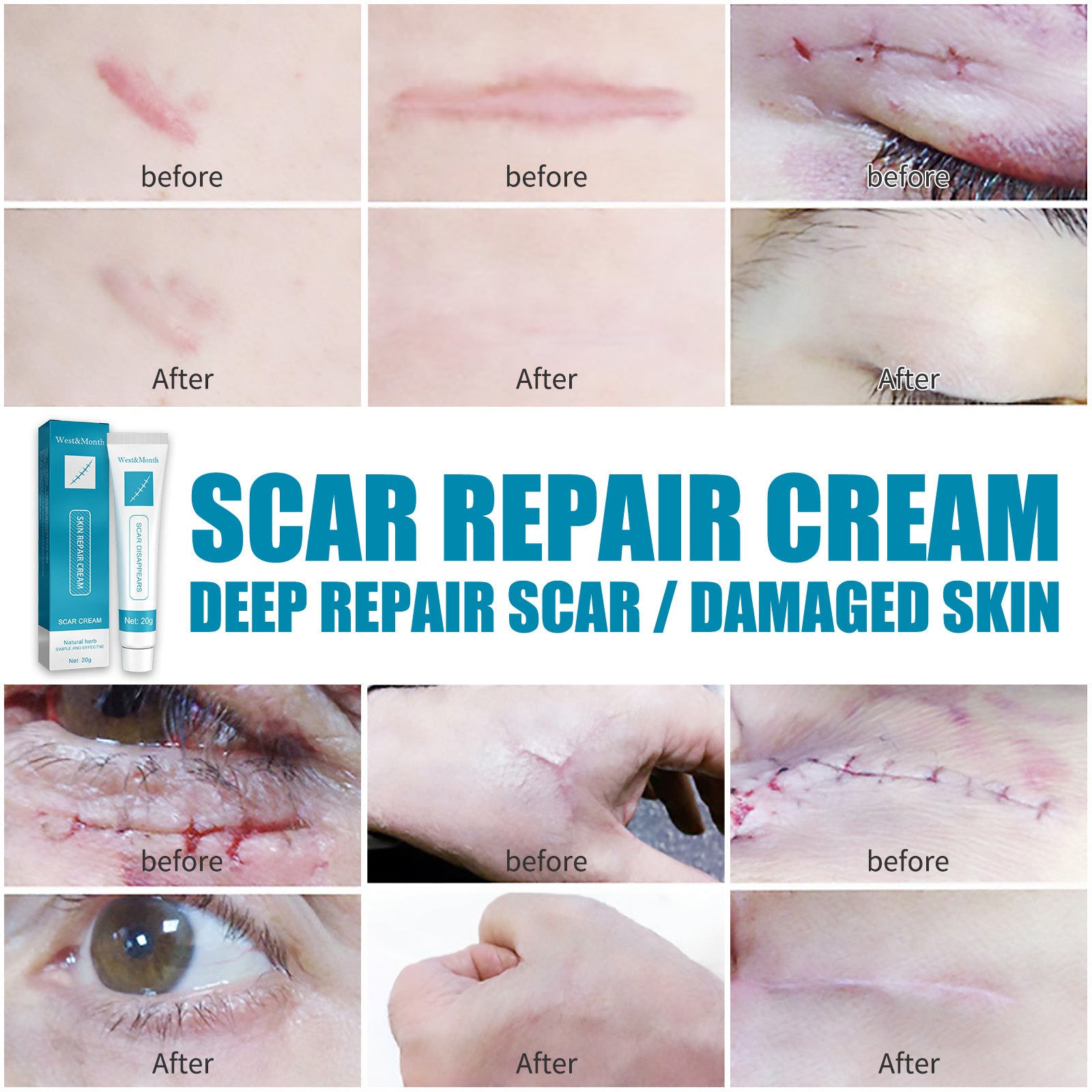 Natural cream scar repair cream scar cream fade hyperplasia pregnancy surgery burn scar skin repair