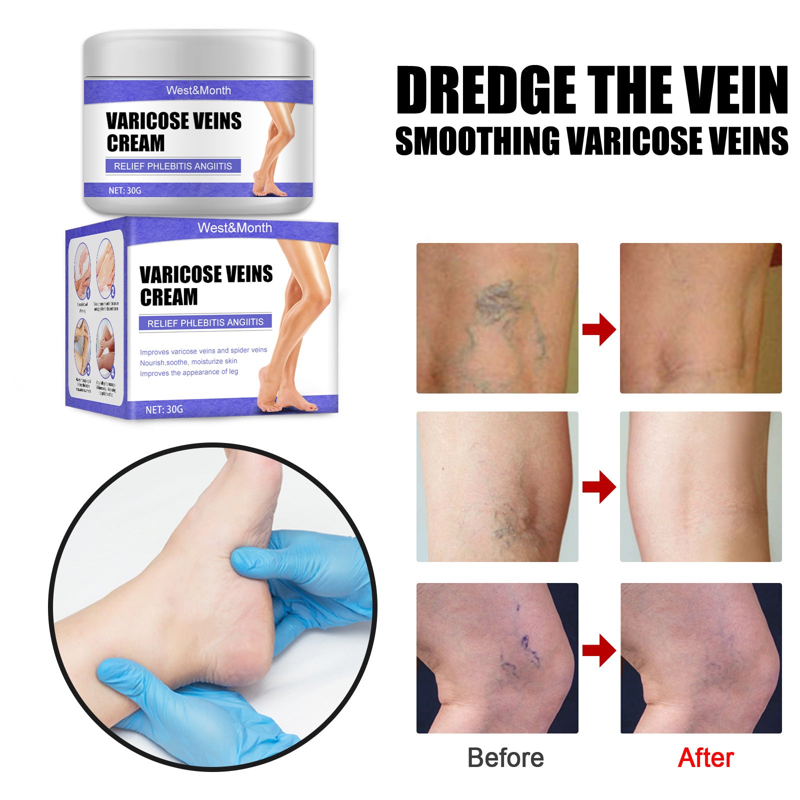 Cream vein cream earthworm leg blue veins bulge relieves pain red blood silk repair cream moisturizes legs