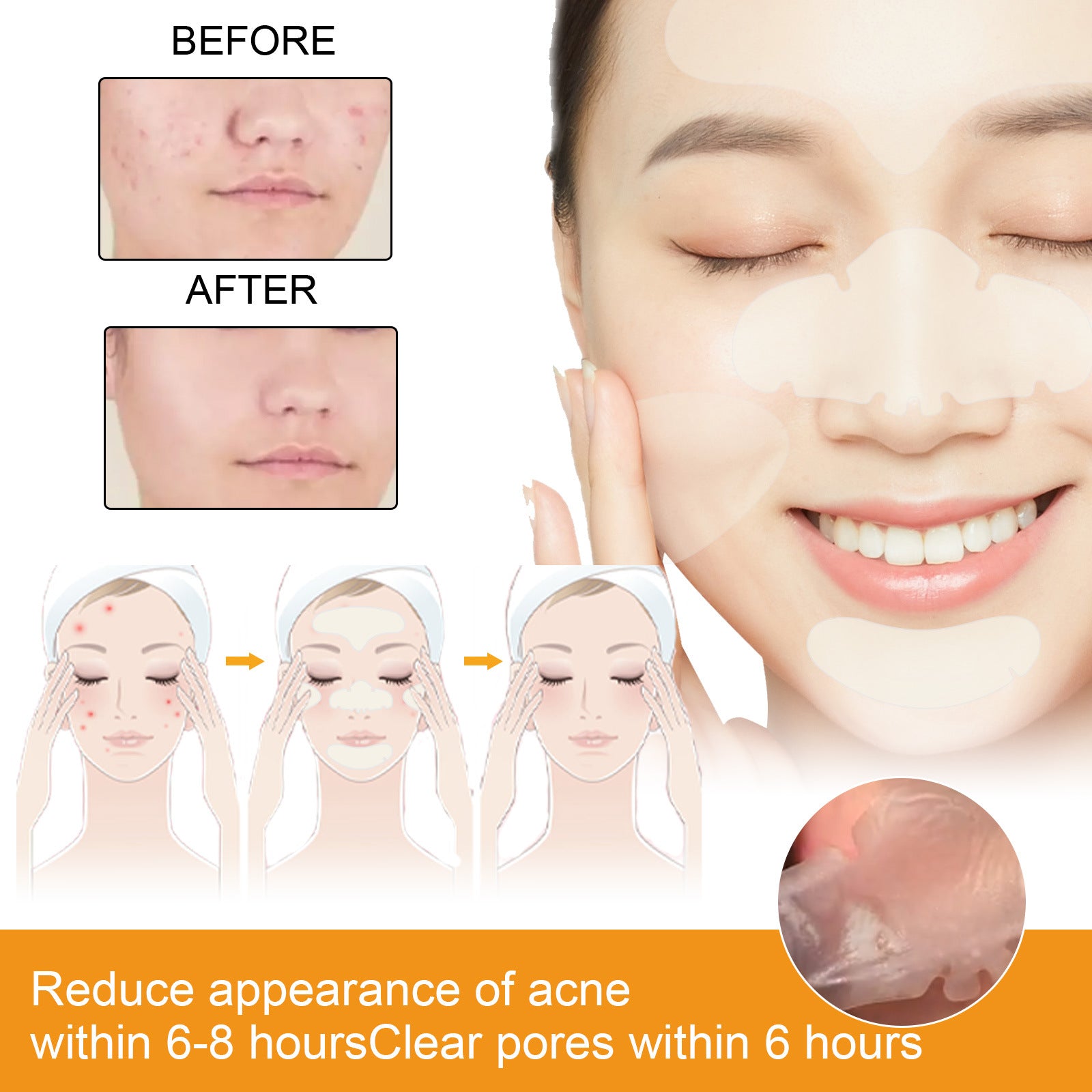 Acne EELHOE Hydrogel Facial Acne Sticker Portable Transparent Invisible Hydrogel Body Facial Care Concealer Anti-Acne Sticker